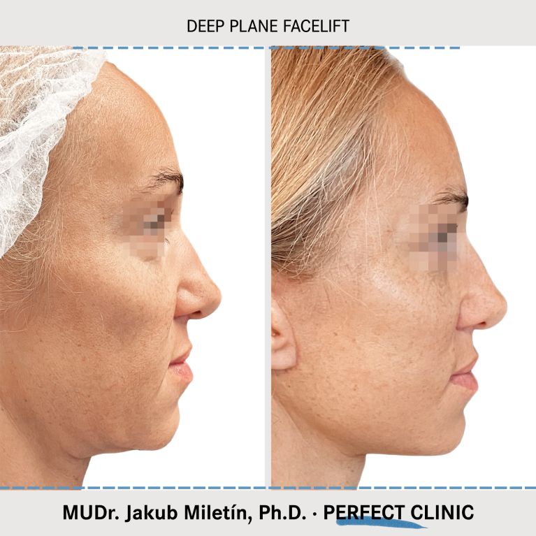 Facelift