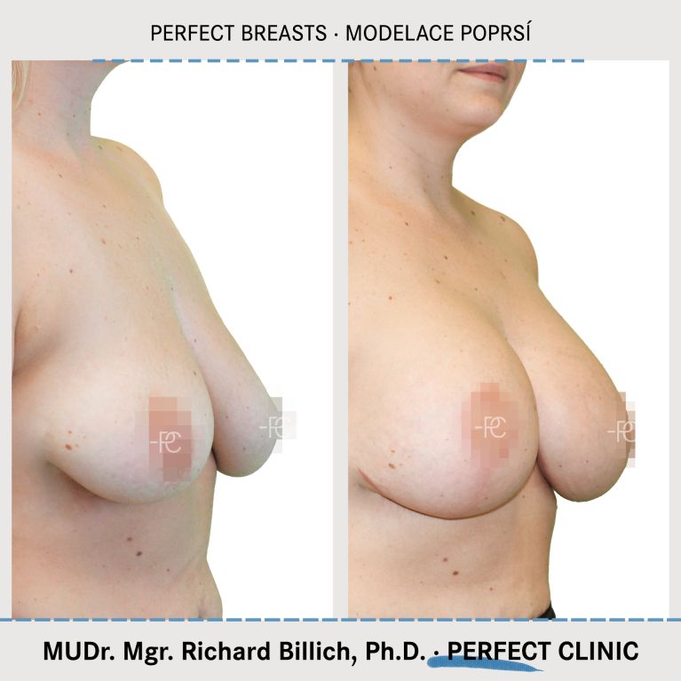 Modelace prsou
