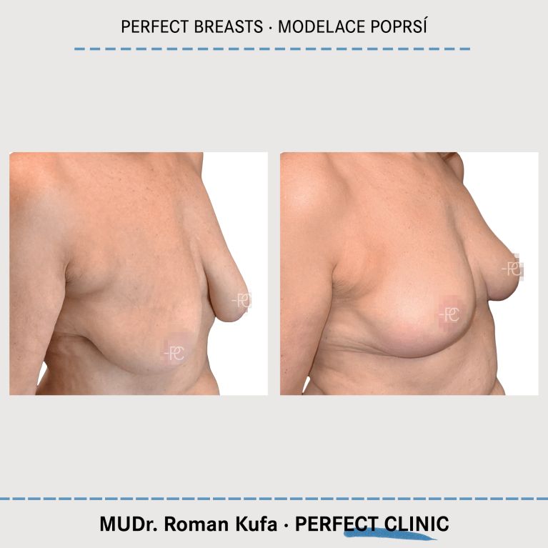 Modelace prsou