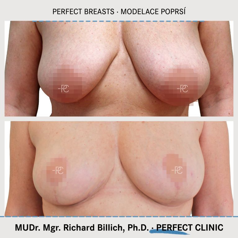 Modelace prsou