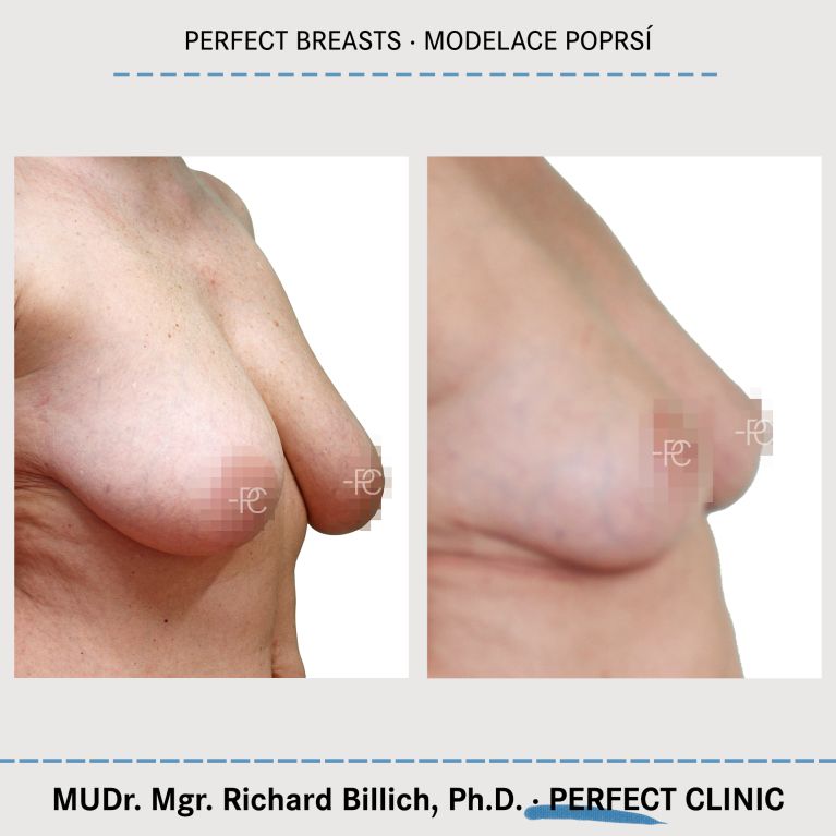 Modelace prsou