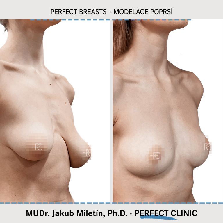 Modelace prsou