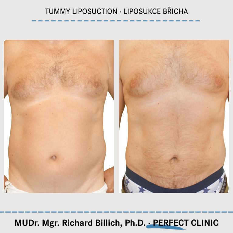 Liposukce