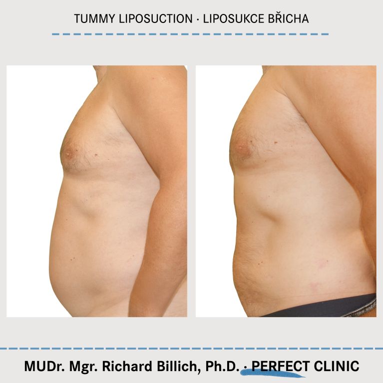 Liposukce