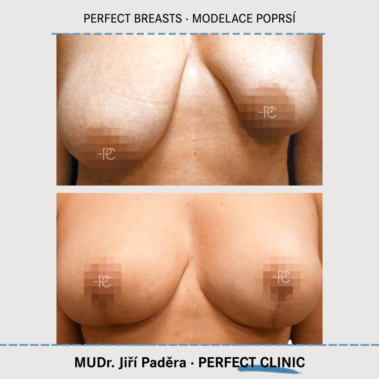 Modelace prsou