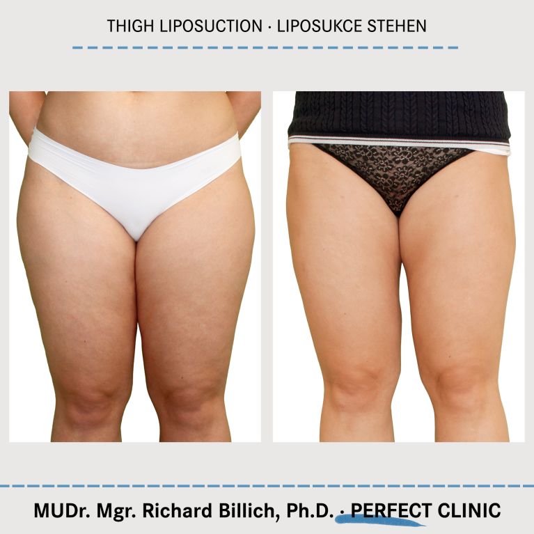 Liposukce