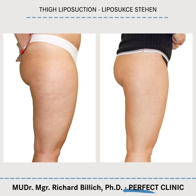 Liposukce