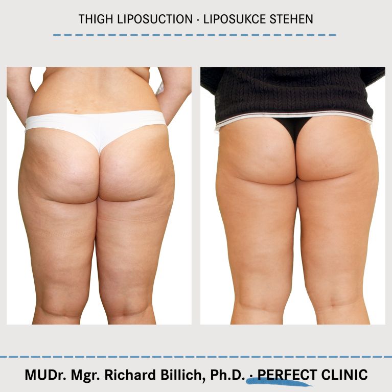 Liposukce