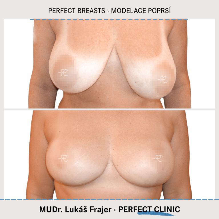 Modelace prsou