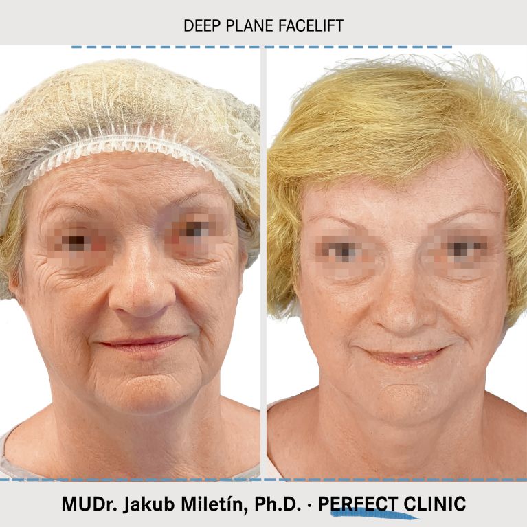 Facelift