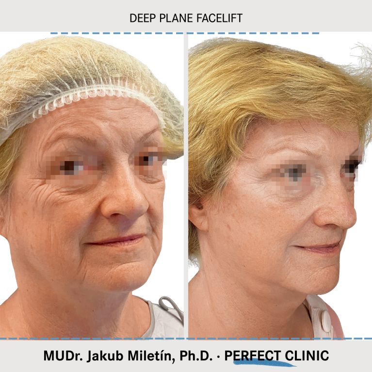 Facelift