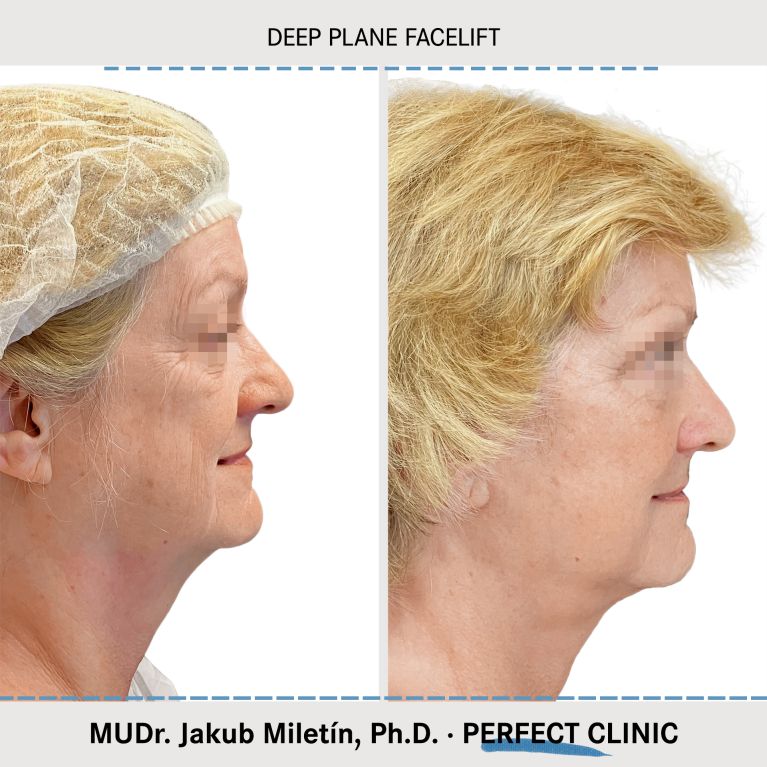 Facelift