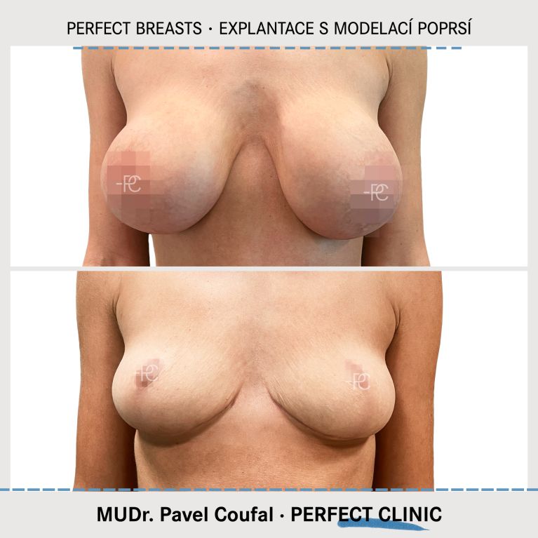Modelace prsou