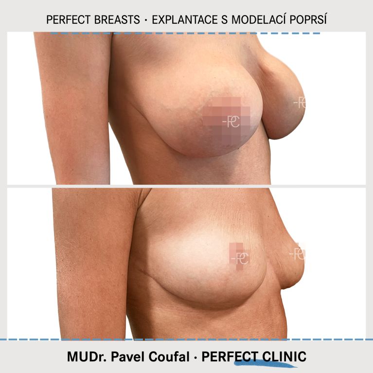 Modelace prsou