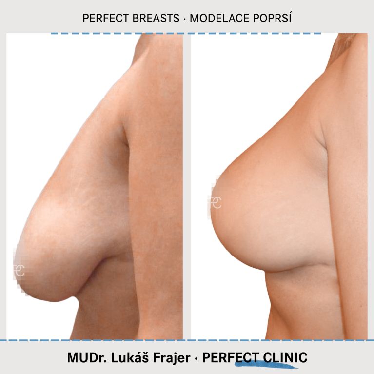 Modelace prsou
