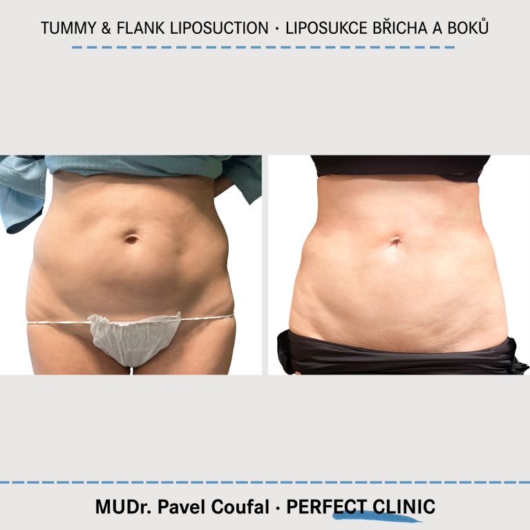 Liposukce