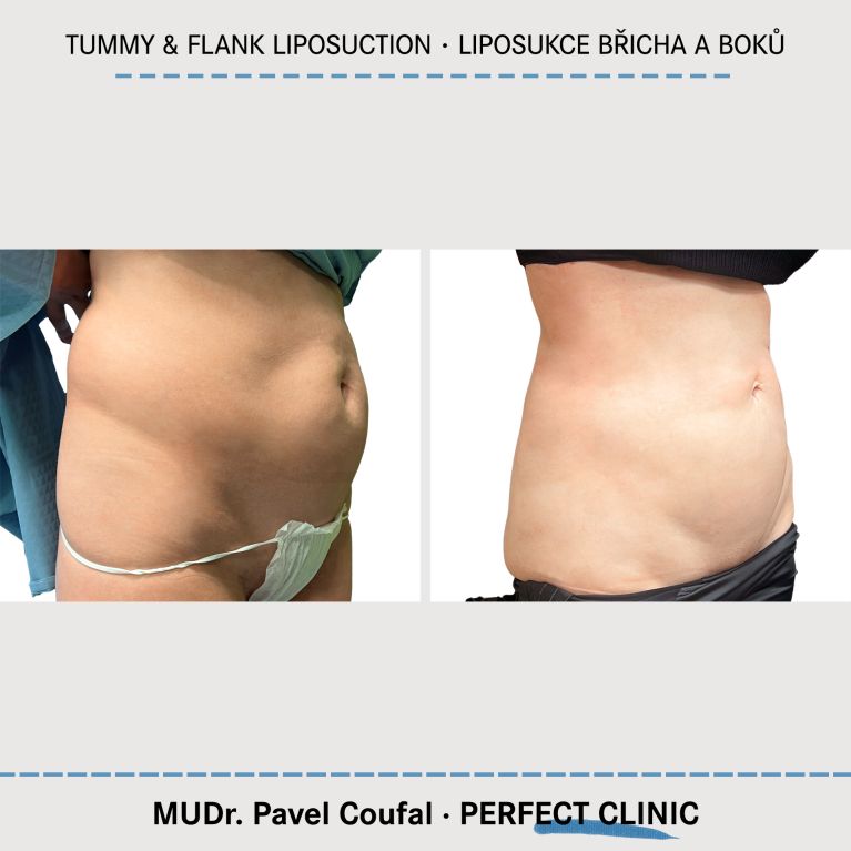 Liposukce