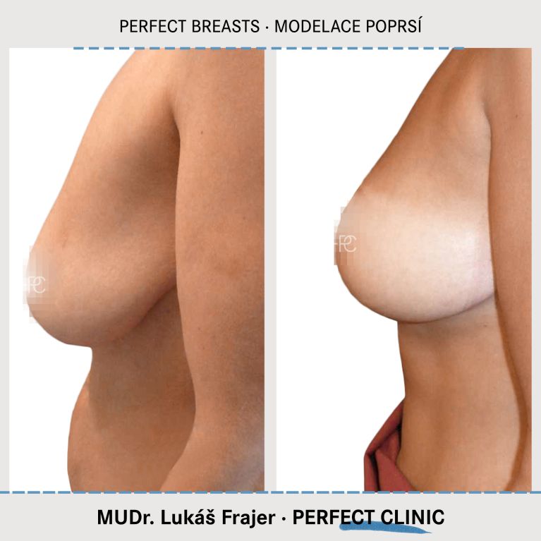Modelace prsou
