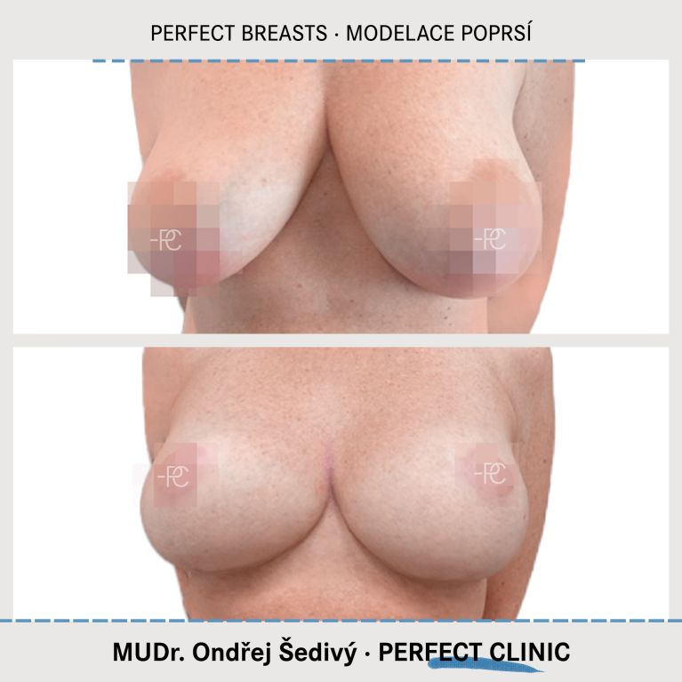 Modelace prsou