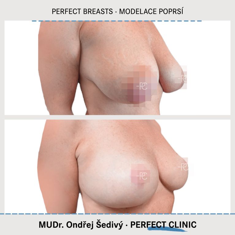 Modelace prsou