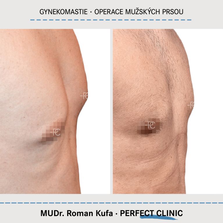 Gynekomastie