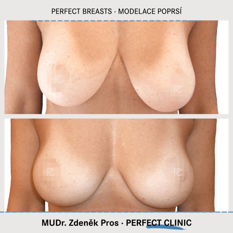 Modelace prsou
