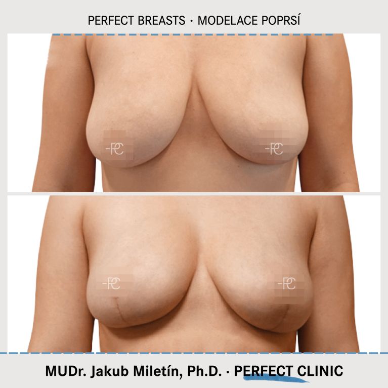 Modelace prsou