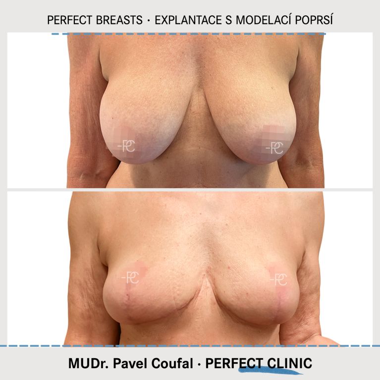 Modelace prsou