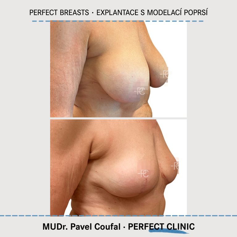 Modelace prsou