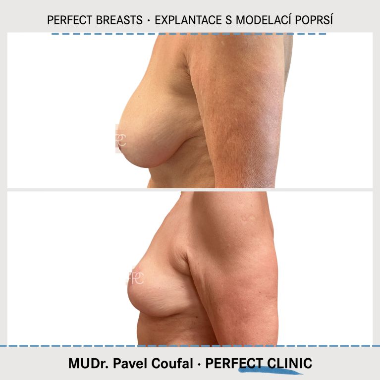 Modelace prsou