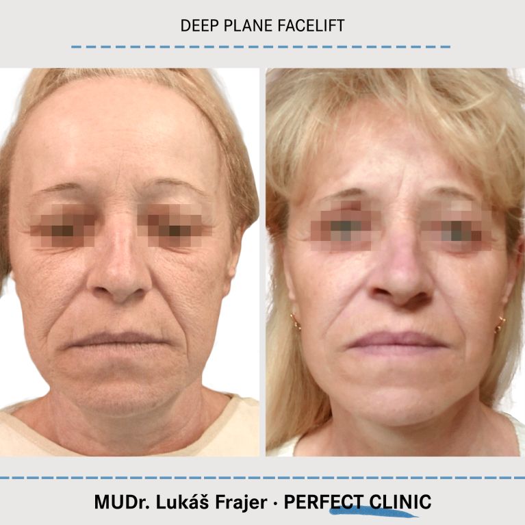 Facelift