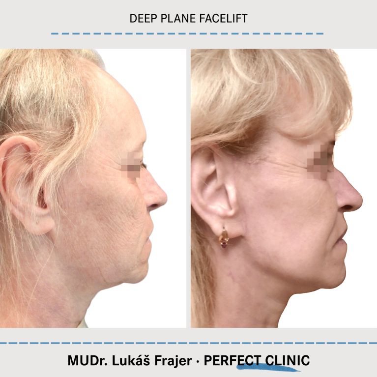 Facelift