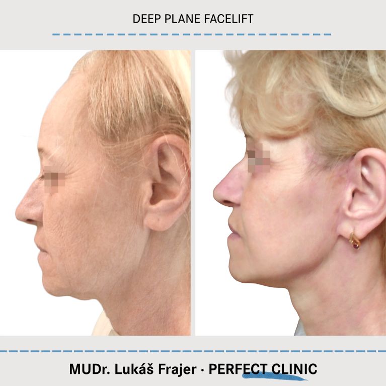 Facelift
