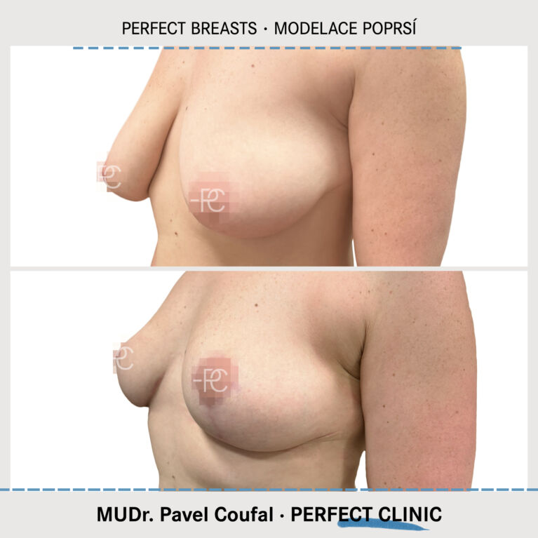 Modelací poprsí