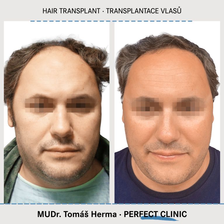 Transplantace vlasů