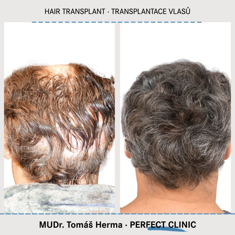 Transplantace vlasů