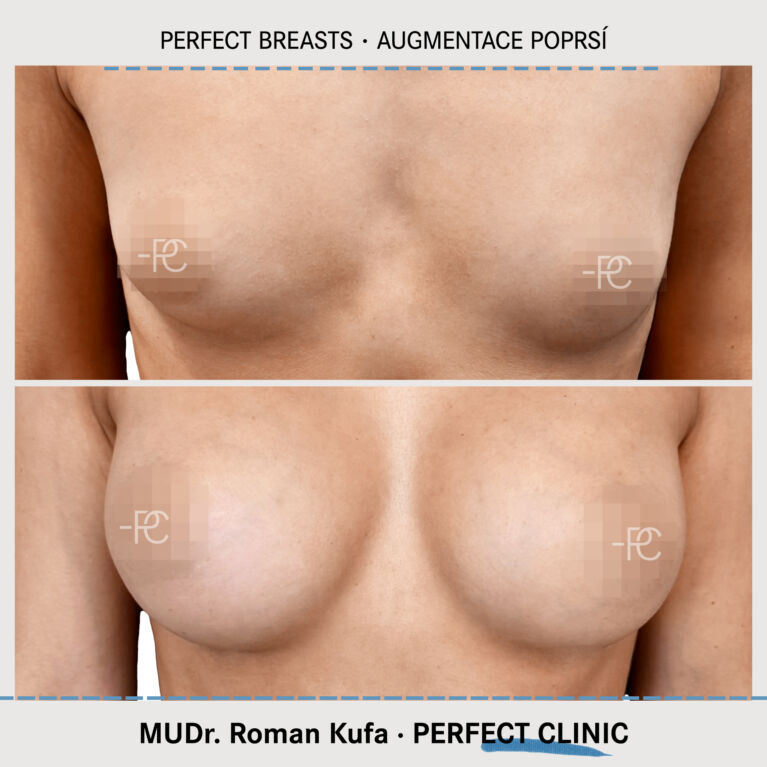 Augmentace poprsí
