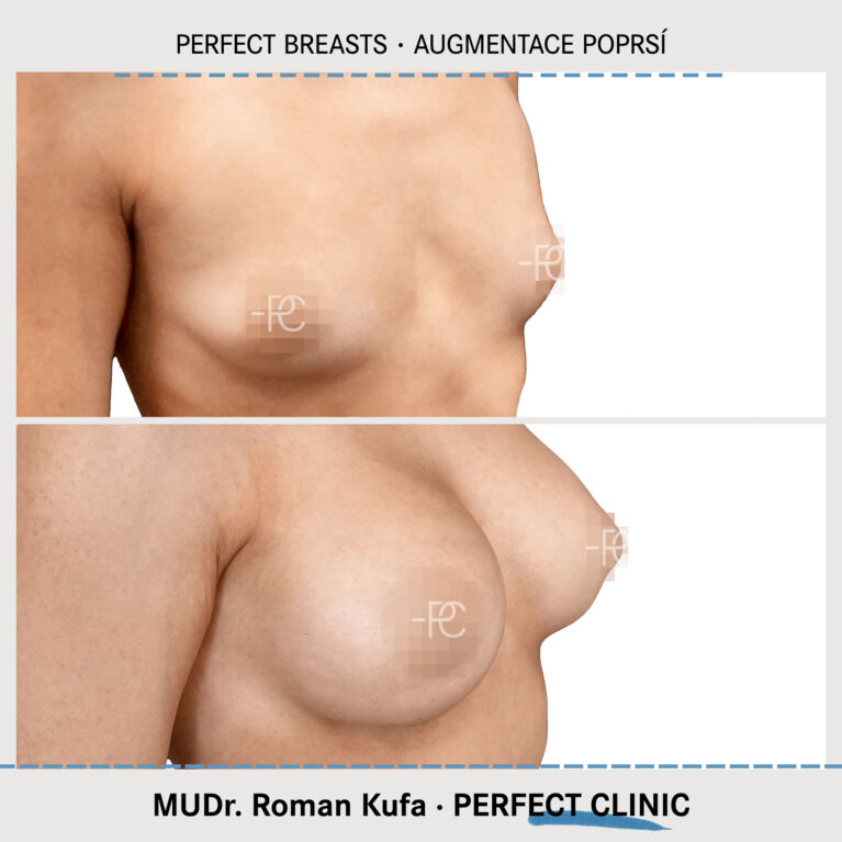 Augmentace poprsí