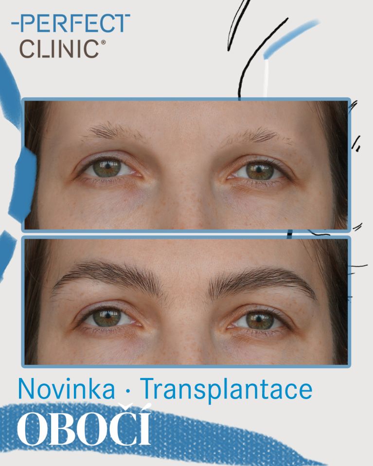 Transplantace obočí: Kdy dává smysl a co od ní čekat