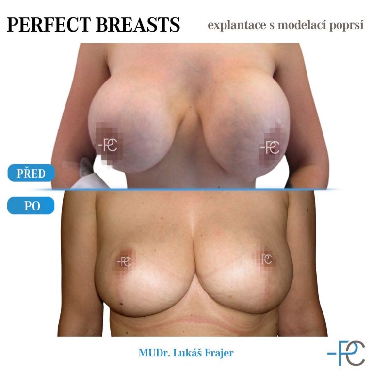 Explantace s modelací poprsí