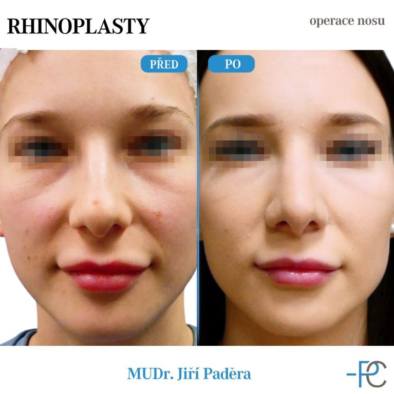 Rhinoplastika