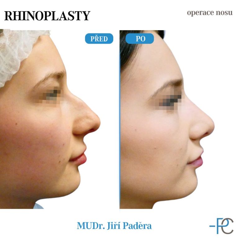 Rhinoplastika