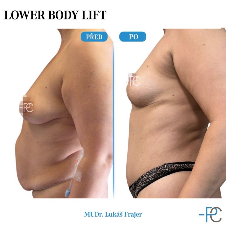Body Sculpting