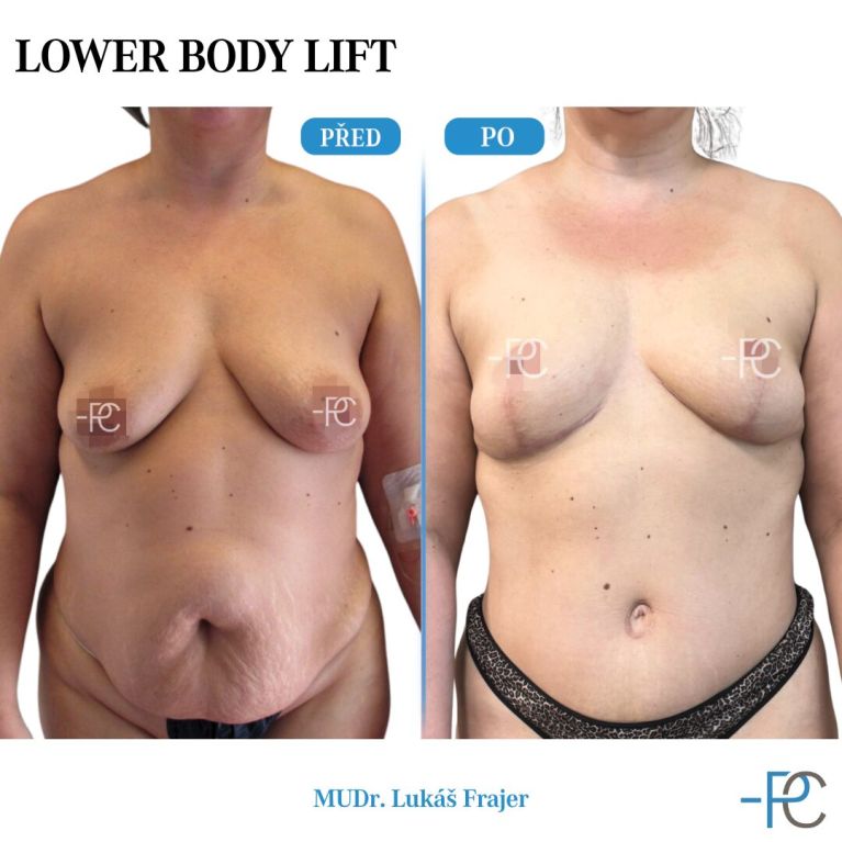 Body Sculpting