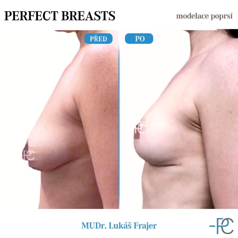 Breast modelling