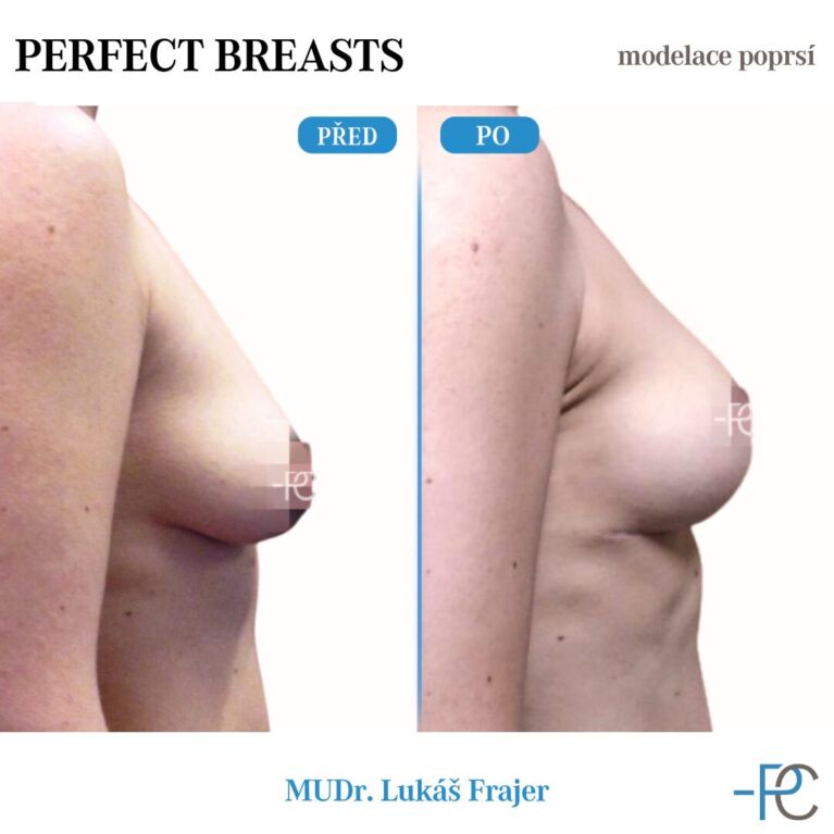 Breast modelling