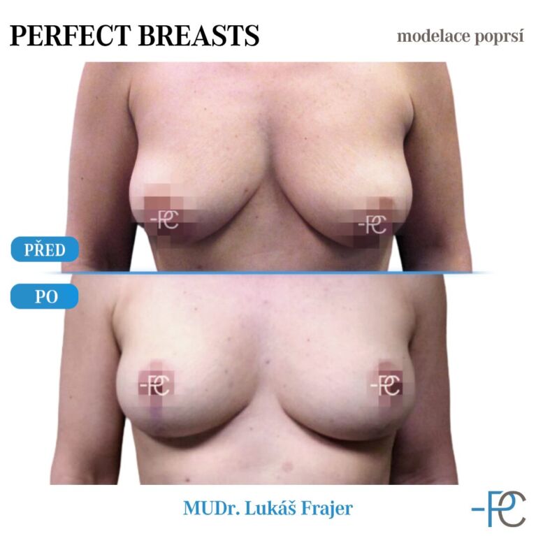Breast modelling