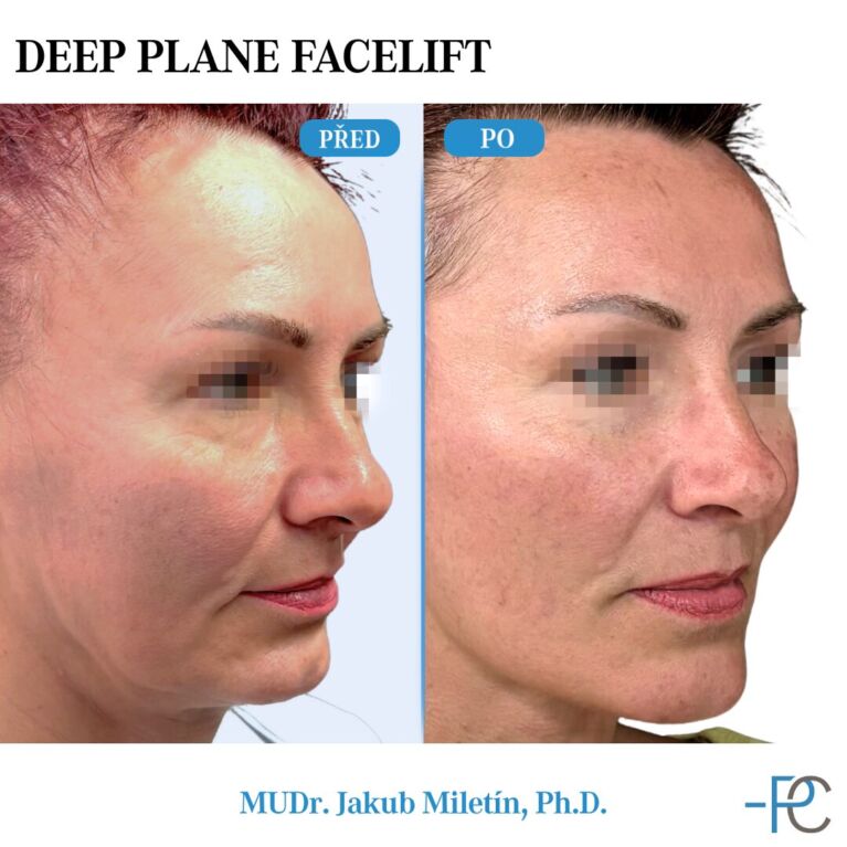 Deep Plane Facelift