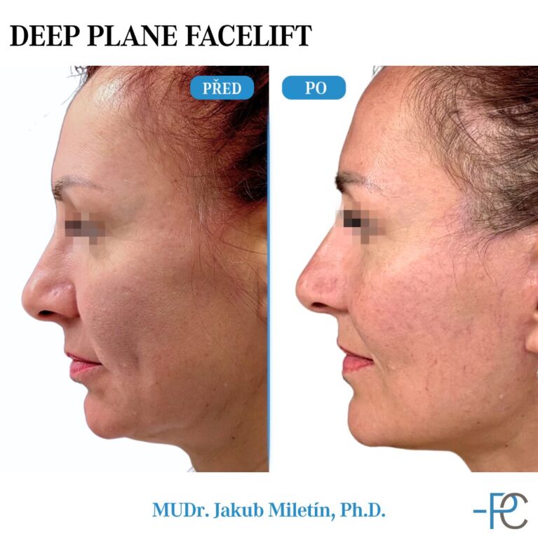 Deep Plane Facelift