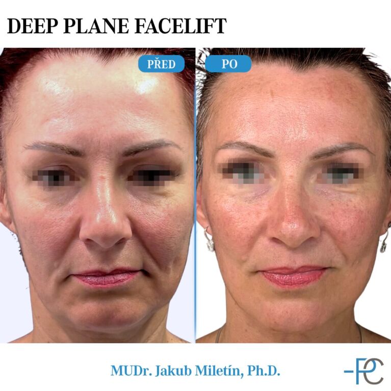 Deep Plane Facelift